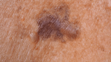 Skin:Wmmm3dij864= Melanoma