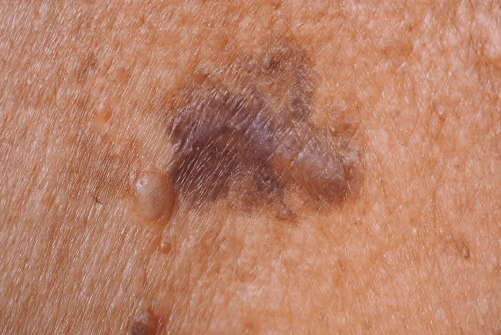 Skin:Wmmm3dij864= Melanoma