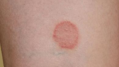Lyme Disease:_Jfclz00o-Q= Ringworm Rash Pictures
