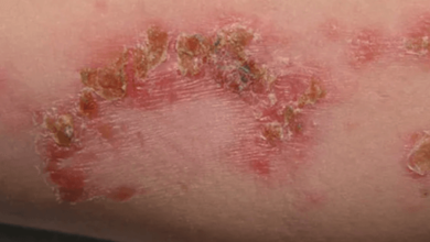 Fungal:Xzuzcgdknwa= Rash