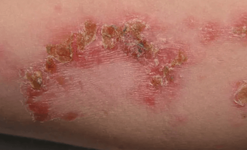 Fungal:Xzuzcgdknwa= Rash